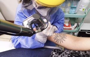 remover tatuaje