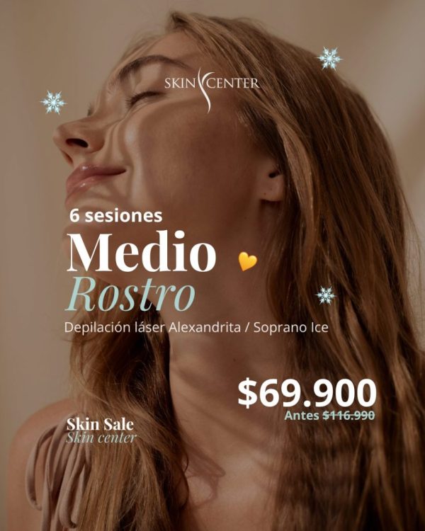 Depilación Alexandrita - 6 ses de Medio Rostro (3 zonas)